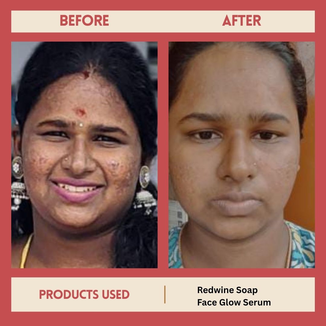 FACE GLOW SERUM AND REDWINE SOAP
